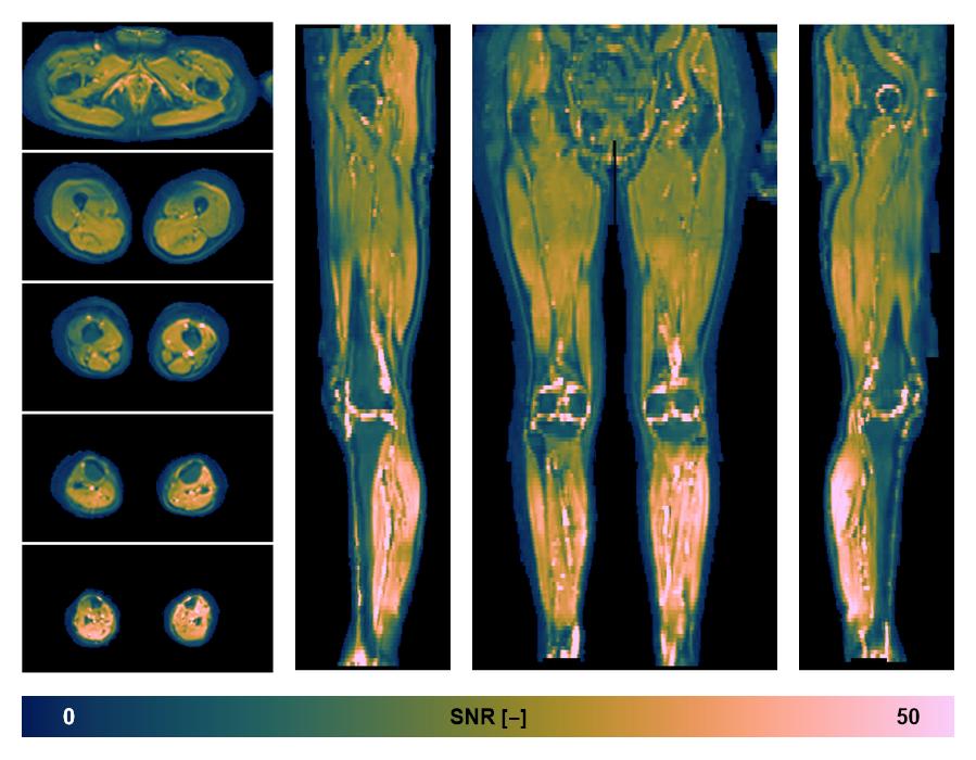 SNR distribution of the unweighted diffusion data.